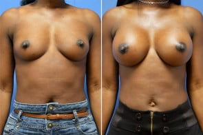 Breast Augmentation Case # 222