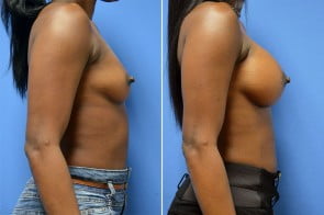 breast-augmentation-6c-branman