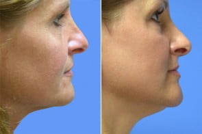 Laser Resurfacing Case # 178