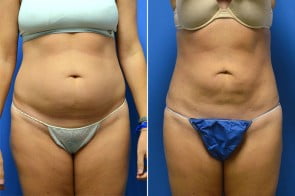 Liposuction Case # 151