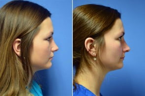 rhinoplasty-01c-branman