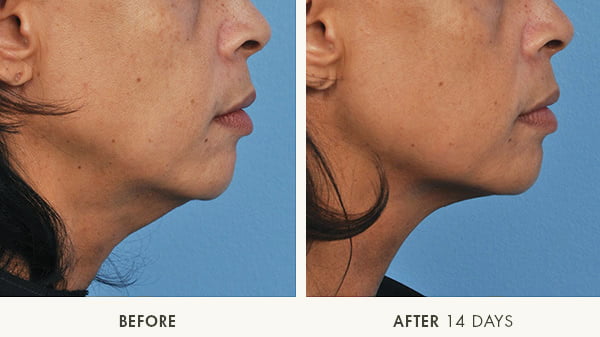 Before & after Ultherapy images from Dr. Rhys Branman