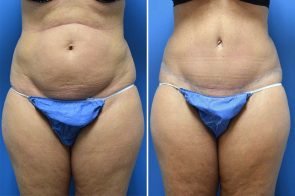 abdominoplasty-159a-branman