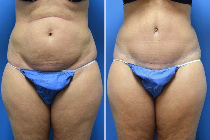 Tummy Tuck Case # 213