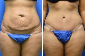 Tummy Tuck Case # 214