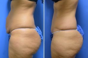 abdominoplasty-160c-branman