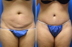 Tummy Tuck Case # 215