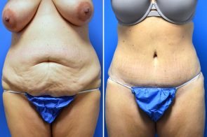 abdominoplasty-162a-branman