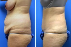 abdominoplasty-162c-branman