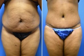 abdominoplasty-163a-branman