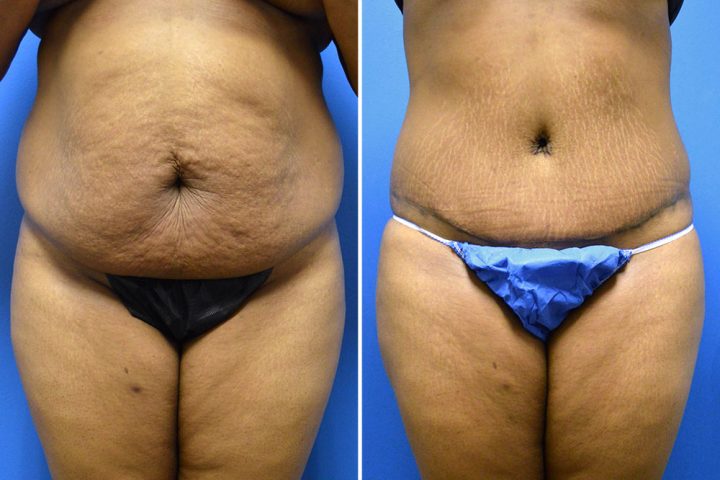 Tummy Tuck Case # 217