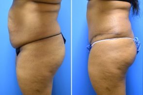 abdominoplasty-163c-branman