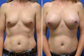 Breast Augmentation Case # 235