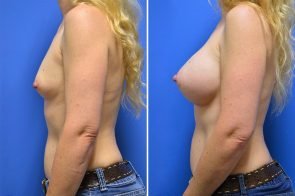 breast-augmentation-235c-branman