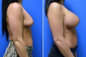 breast-augmentation-236c-branman