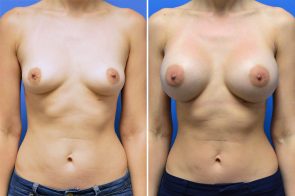 breast-augmentation-237a-branman