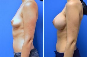 breast-augmentation-237c-branman