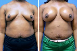 breast-augmentation-238a-branman