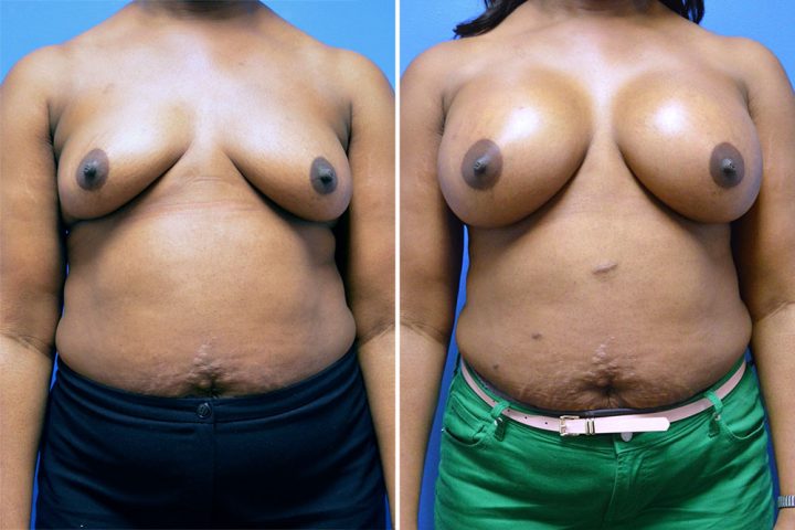 Breast Augmentation Case # 238