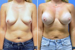 breast-augmentation-239a-branman