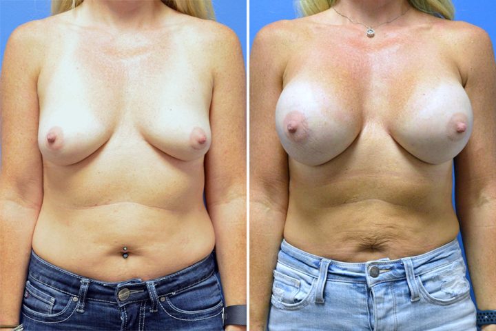 Breast Augmentation Case # 239