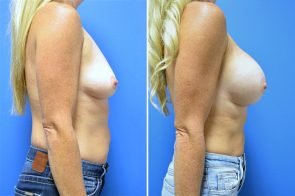 breast-augmentation-239c-branman