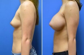 breast-augmentation-241c-branman