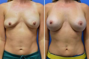 breast-augmentation-242a-branman