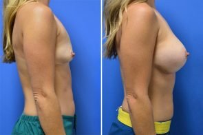 breast-augmentation-242c-branman