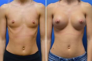 Breast Augmentation Case # 243