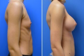 breast-augmentation-243c-branman