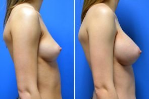 breast-augmentation-245c-branman