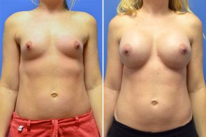 breast-augmentation-246a-branman