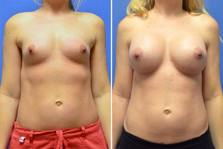 Breast Augmentation Case # 246