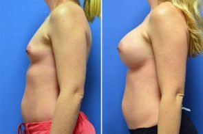breast-augmentation-246c-branman