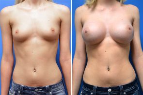 breast-augmentation-247a-branman