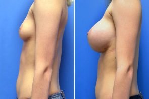 breast-augmentation-247c-branman