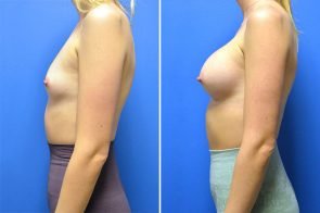 breast-augmentation-248c-branman