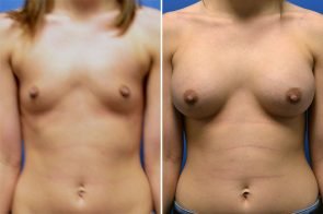 breast-augmentation-249a-branman