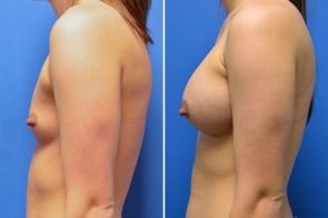 breast-augmentation-249c-branman