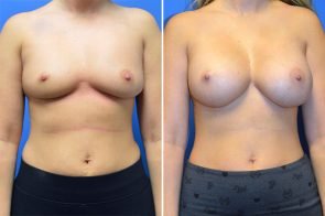 Breast Augmentation Case # 250