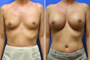 breast-augmentation-251a-branman