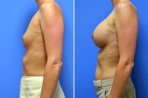 breast-augmentation-251c-branman