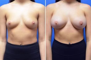 breast-augmentation-252a-branman