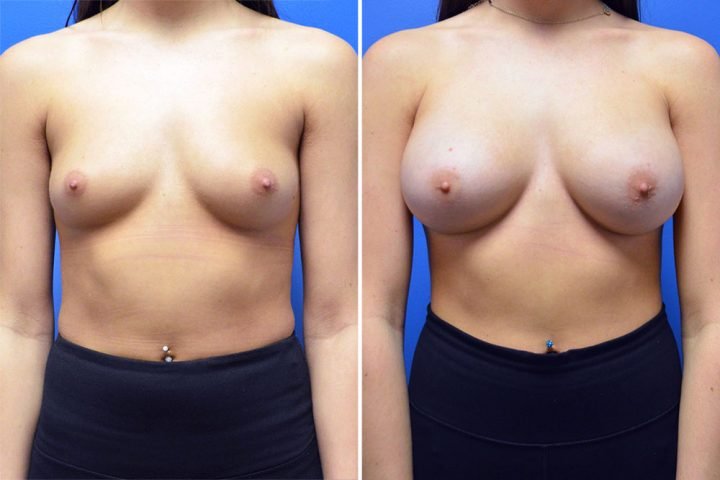 Breast Augmentation Case # 252