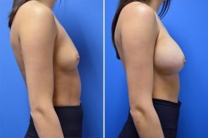 breast-augmentation-252c-branman