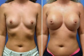 breast-augmentation-253a-branman