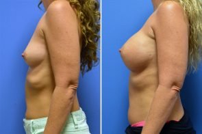 breast-augmentation-253c-branman