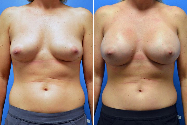 Breast Augmentation Case # 254