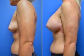 breast-augmentation-254c-branman
